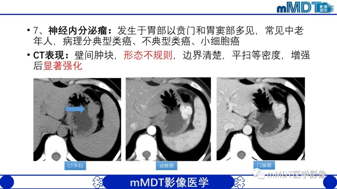 影像PPT - 【PPT】胃血管球瘤的影像诊断-19 影像PPT - 【PPT】胃血管球瘤的影像诊断-19