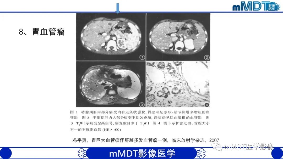 影像PPT - 【PPT】胃血管球瘤的影像诊断-20 影像PPT - 【PPT】胃血管球瘤的影像诊断-20