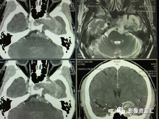 影像PPT - 听神经瘤影像要点及鉴别诊断-22 影像PPT - 听神经瘤影像要点及鉴别诊断-22