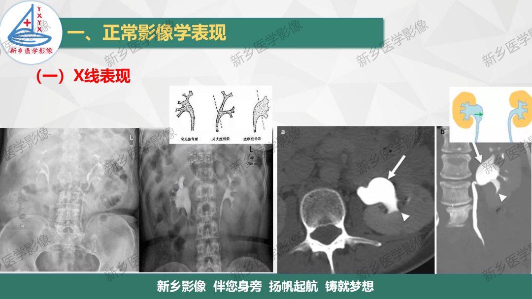 影像PPT - 【PPT】泌尿生殖系统解剖及基本病变影像表现-7