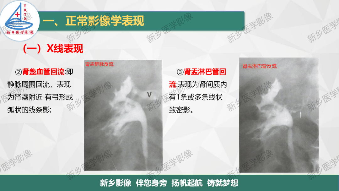 影像PPT - 【PPT】泌尿生殖系统解剖及基本病变影像表现-12