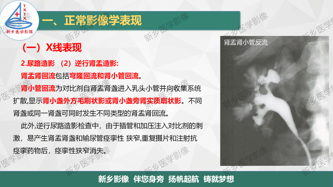 影像PPT - 【PPT】泌尿生殖系统解剖及基本病变影像表现-13