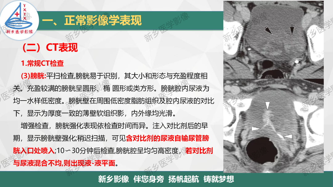影像PPT - 【PPT】泌尿生殖系统解剖及基本病变影像表现-18