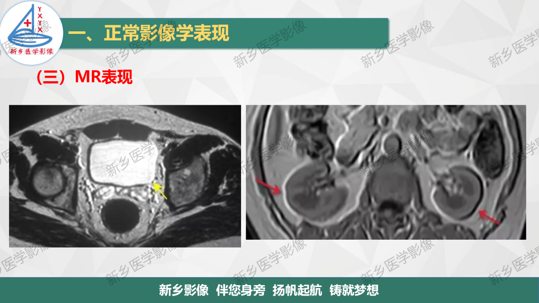 影像PPT - 【PPT】泌尿生殖系统解剖及基本病变影像表现-22