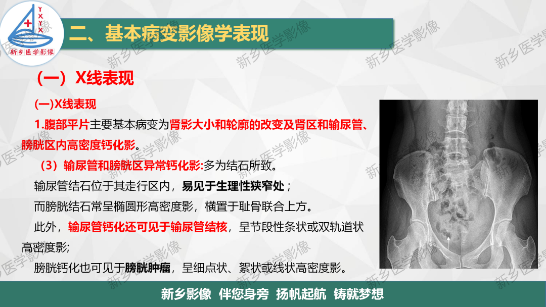 影像PPT - 【PPT】泌尿生殖系统解剖及基本病变影像表现-25