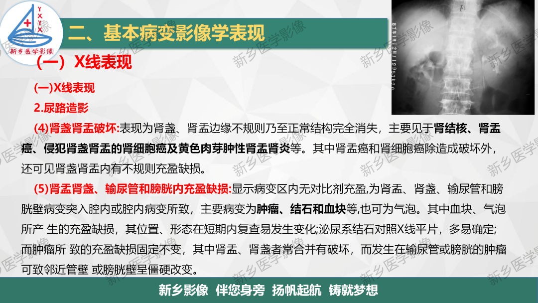 影像PPT - 【PPT】泌尿生殖系统解剖及基本病变影像表现-27