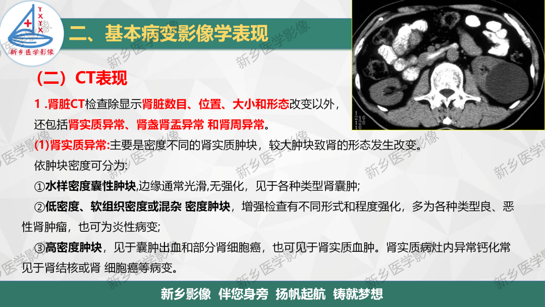 影像PPT - 【PPT】泌尿生殖系统解剖及基本病变影像表现-30
