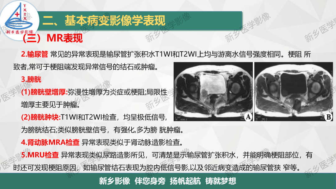 影像PPT - 【PPT】泌尿生殖系统解剖及基本病变影像表现-35