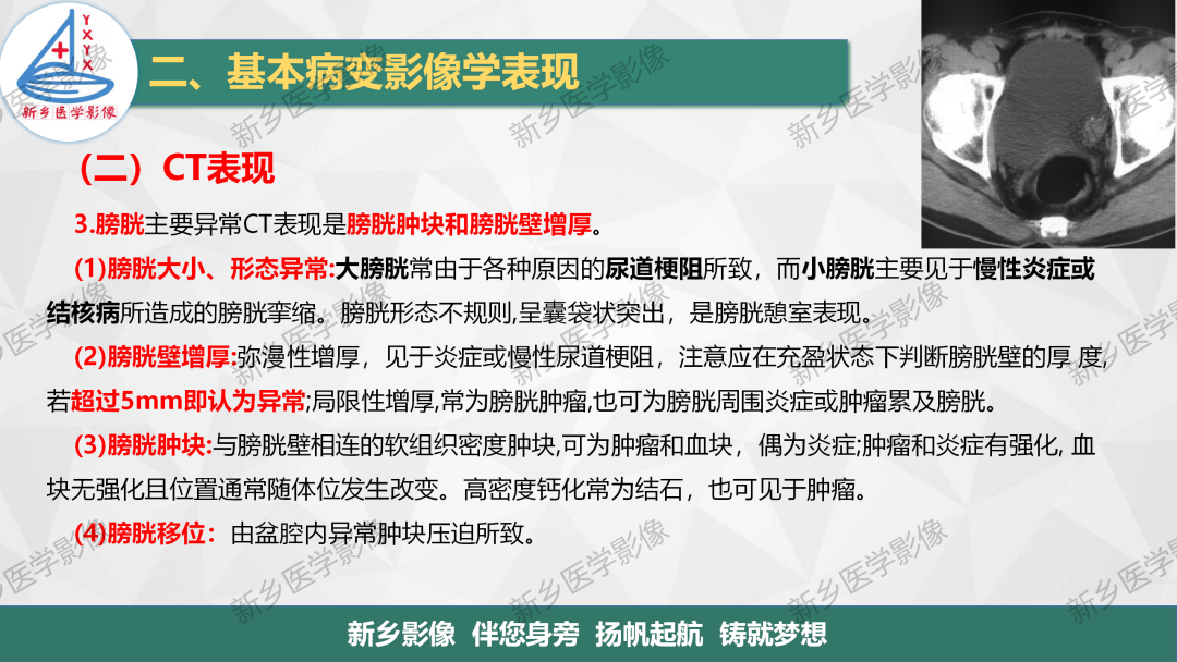 影像PPT - 【PPT】泌尿生殖系统解剖及基本病变影像表现-33
