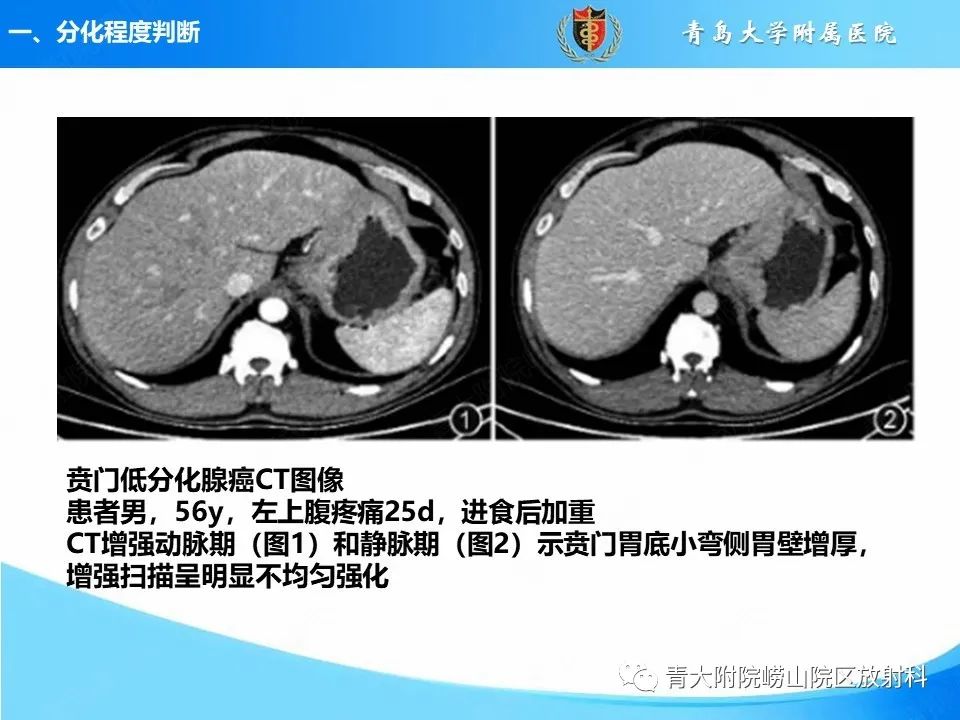 影像PPT - 【PPT】CT对胃癌诊断和临床应用价值-7