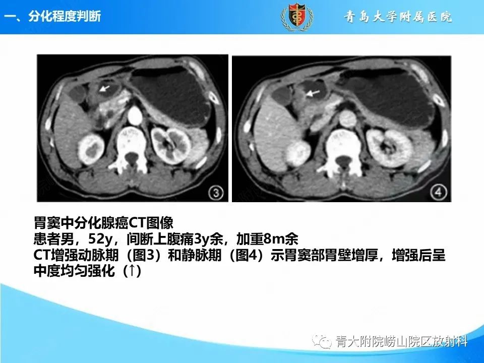 影像PPT - 【PPT】CT对胃癌诊断和临床应用价值-8
