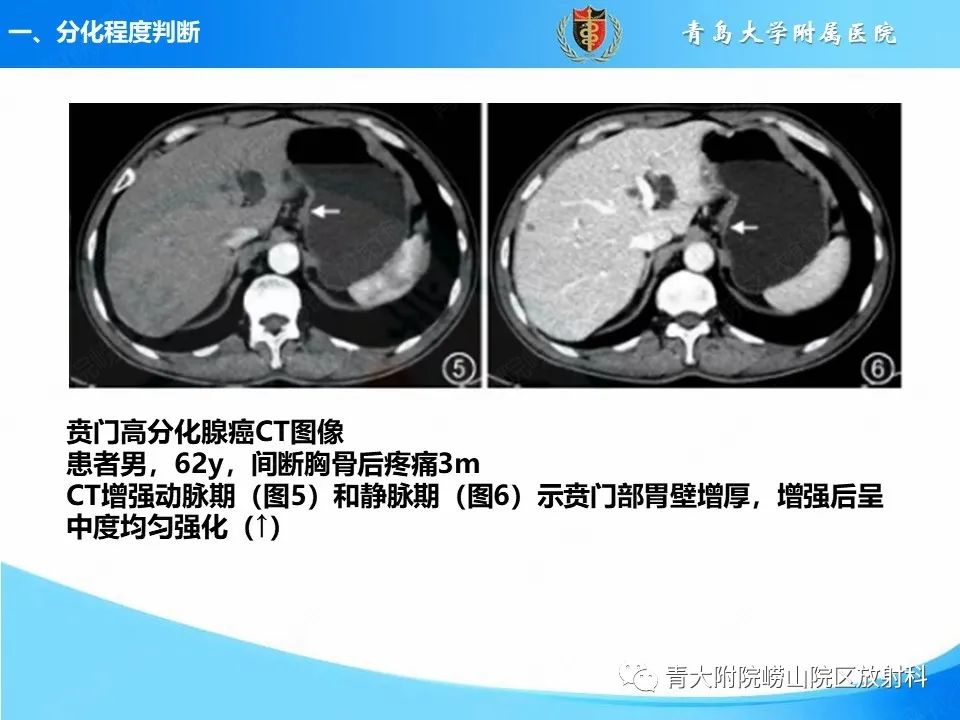 影像PPT - 【PPT】CT对胃癌诊断和临床应用价值-9
