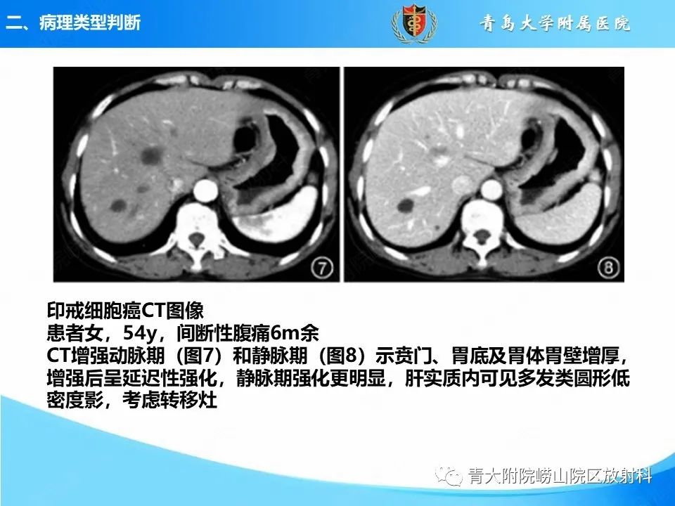 影像PPT - 【PPT】CT对胃癌诊断和临床应用价值-15