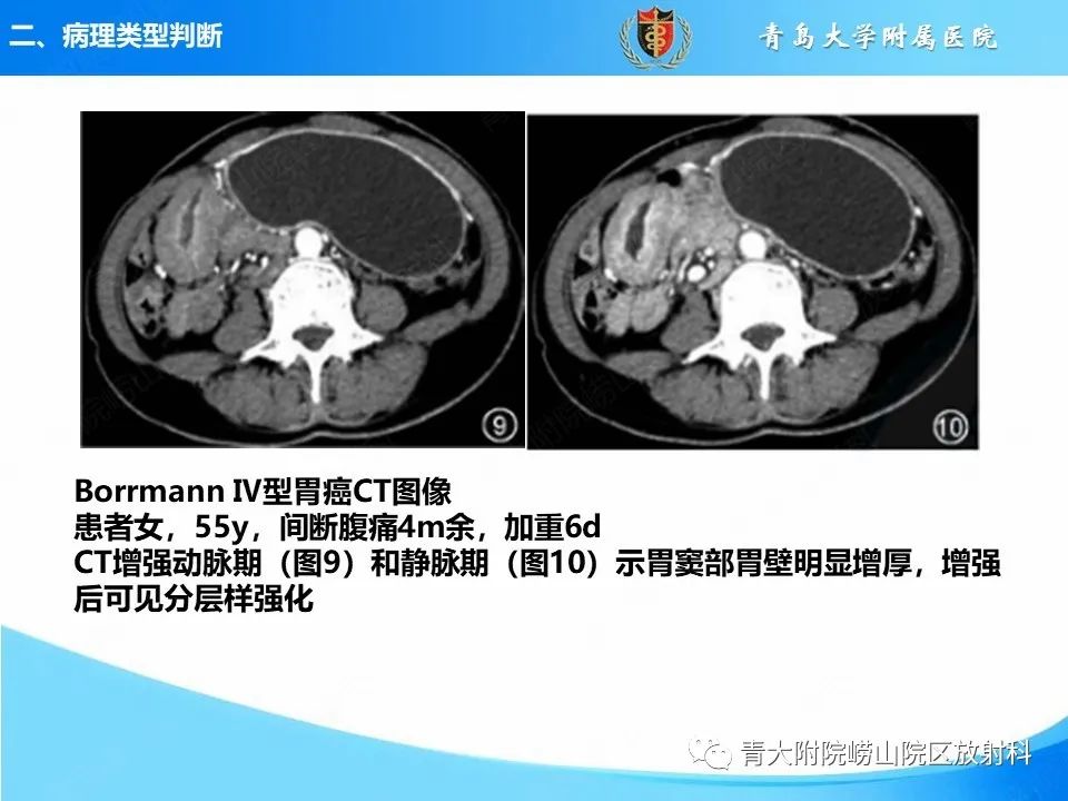 影像PPT - 【PPT】CT对胃癌诊断和临床应用价值-17