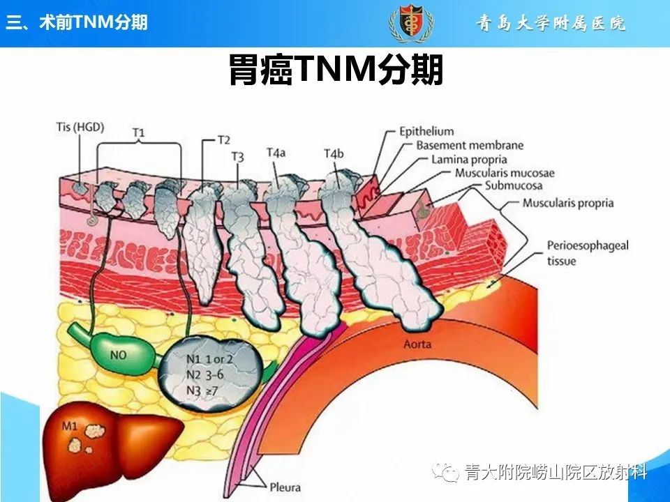 影像PPT - 【PPT】CT对胃癌诊断和临床应用价值-21