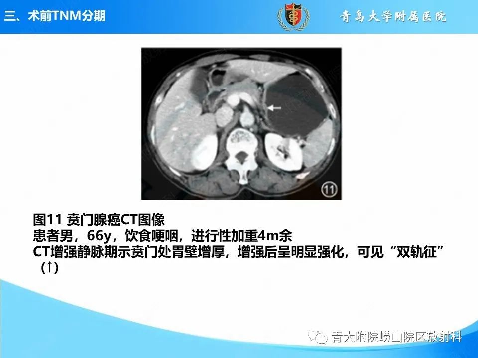 影像PPT - 【PPT】CT对胃癌诊断和临床应用价值-24