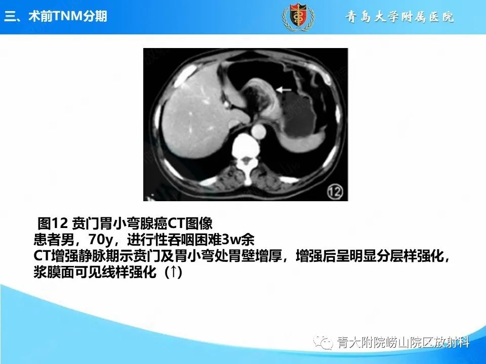 影像PPT - 【PPT】CT对胃癌诊断和临床应用价值-26