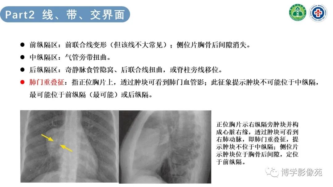 影像PPT - 【PPT】纵隔疾病-8