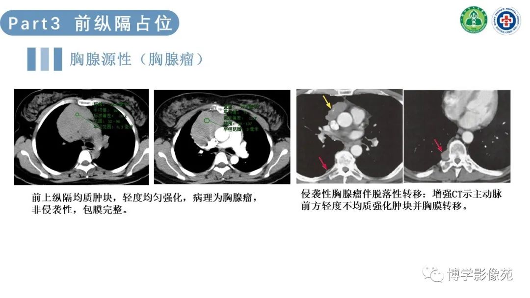 影像PPT - 【PPT】纵隔疾病-11