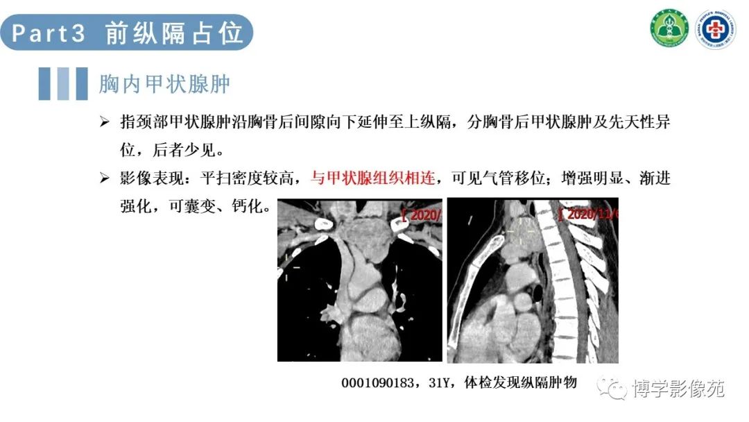 影像PPT - 【PPT】纵隔疾病-15