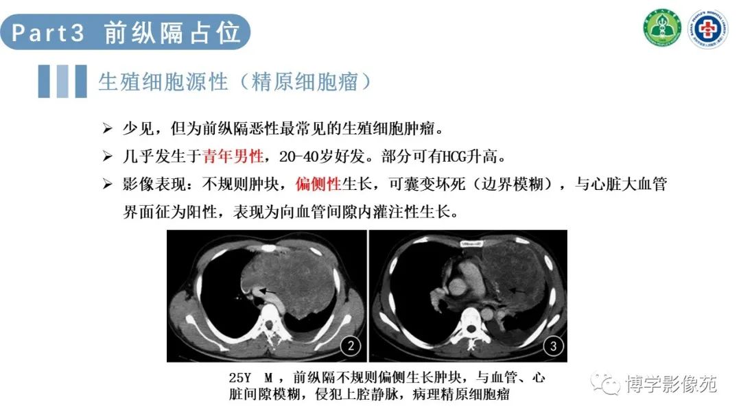 影像PPT - 【PPT】纵隔疾病-14