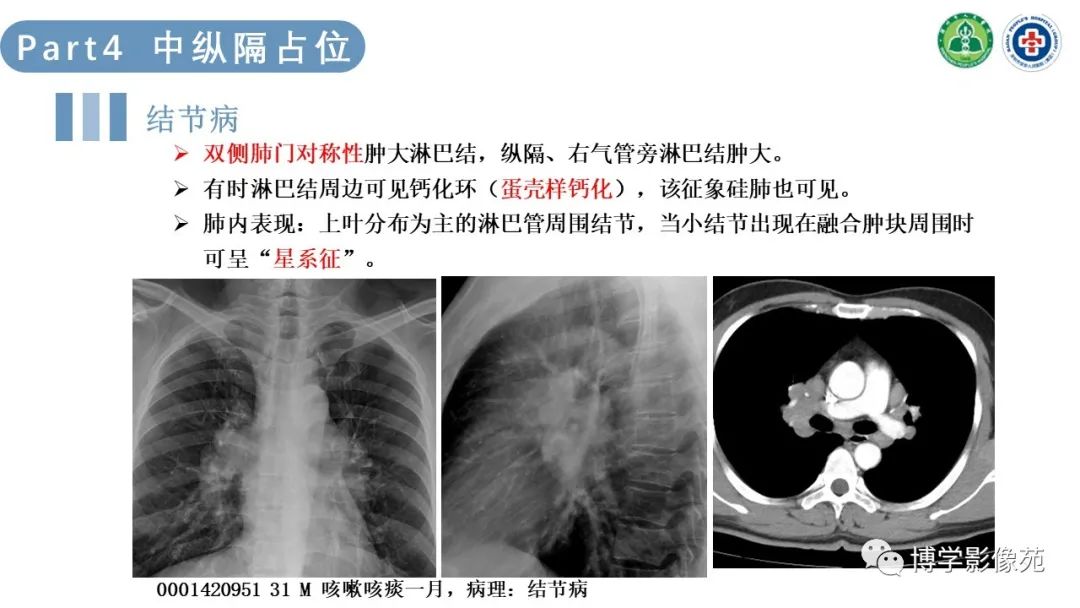 影像PPT - 【PPT】纵隔疾病-18