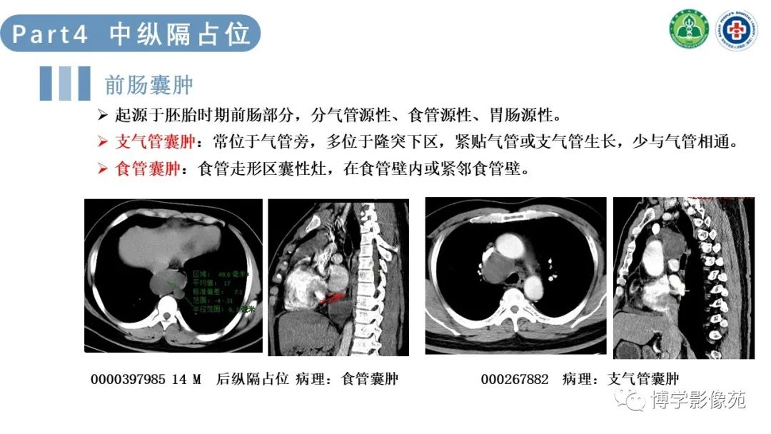 影像PPT - 【PPT】纵隔疾病-20