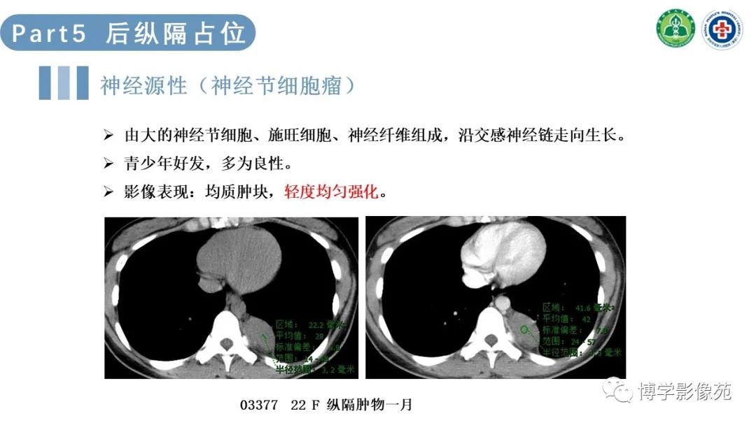 影像PPT - 【PPT】纵隔疾病-24