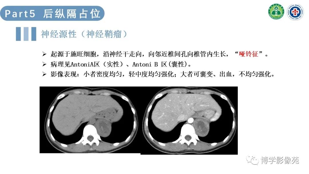 影像PPT - 【PPT】纵隔疾病-23