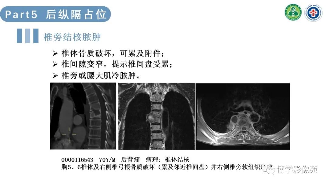 影像PPT - 【PPT】纵隔疾病-25