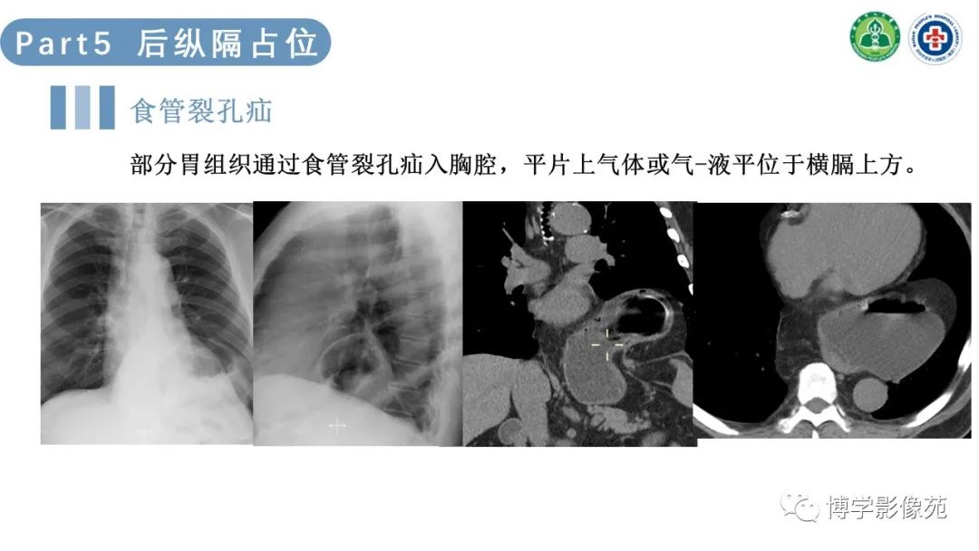 影像PPT - 【PPT】纵隔疾病-26