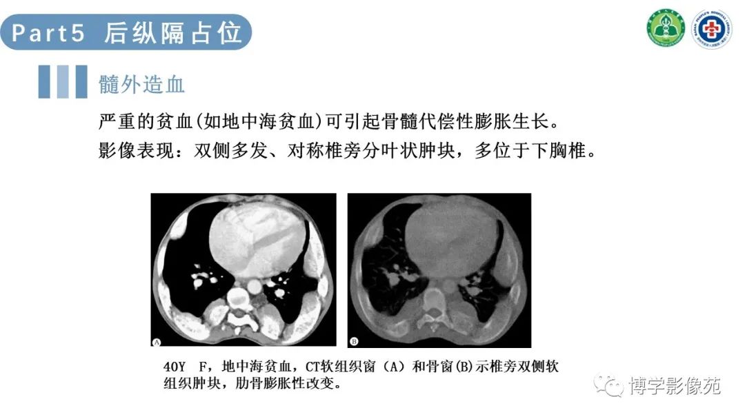 影像PPT - 【PPT】纵隔疾病-27
