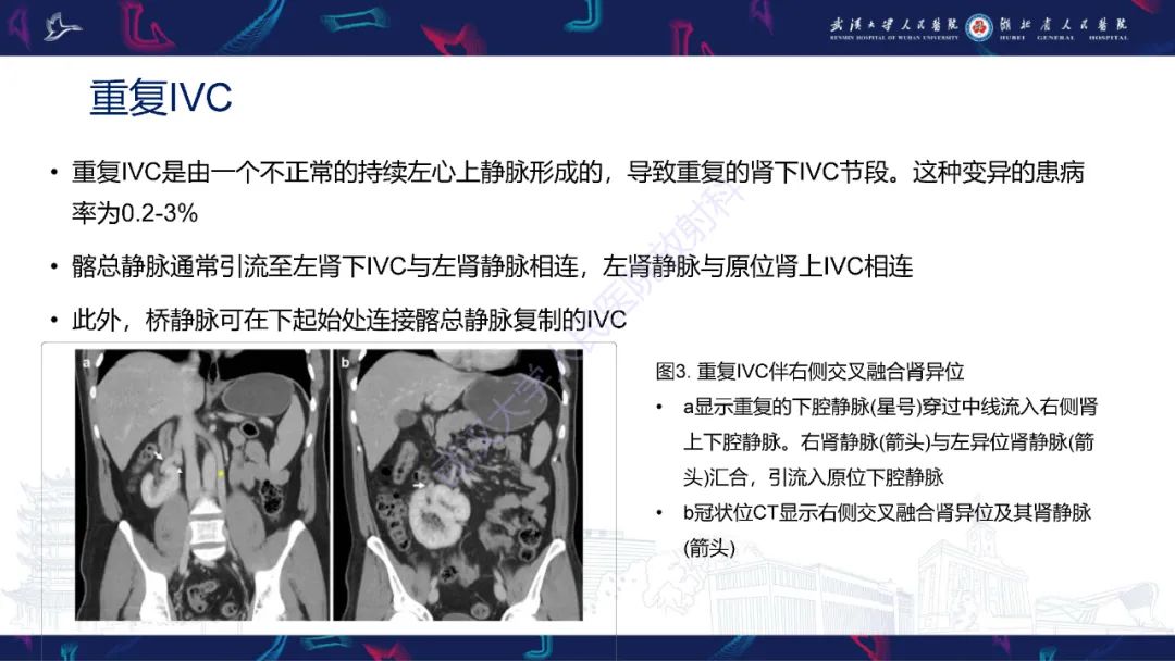 影像PPT - 【PPT】下腔静脉解剖变异及病变影像诊断-7