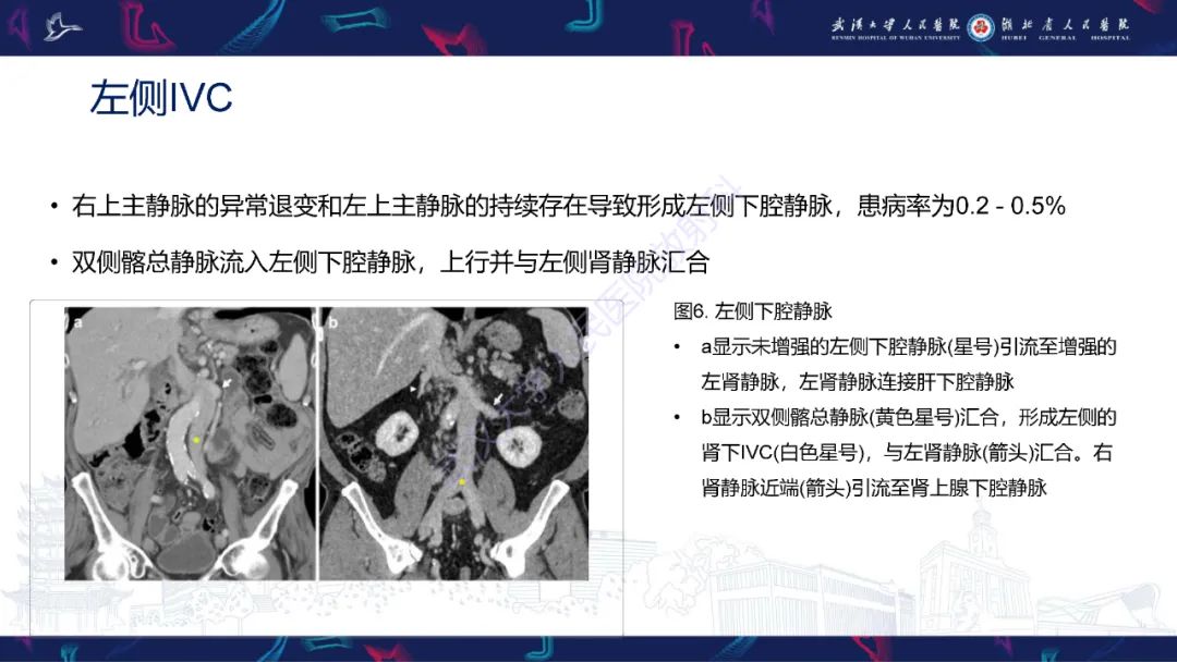 影像PPT - 【PPT】下腔静脉解剖变异及病变影像诊断-9