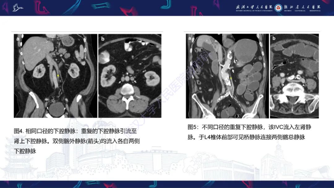 影像PPT - 【PPT】下腔静脉解剖变异及病变影像诊断-8