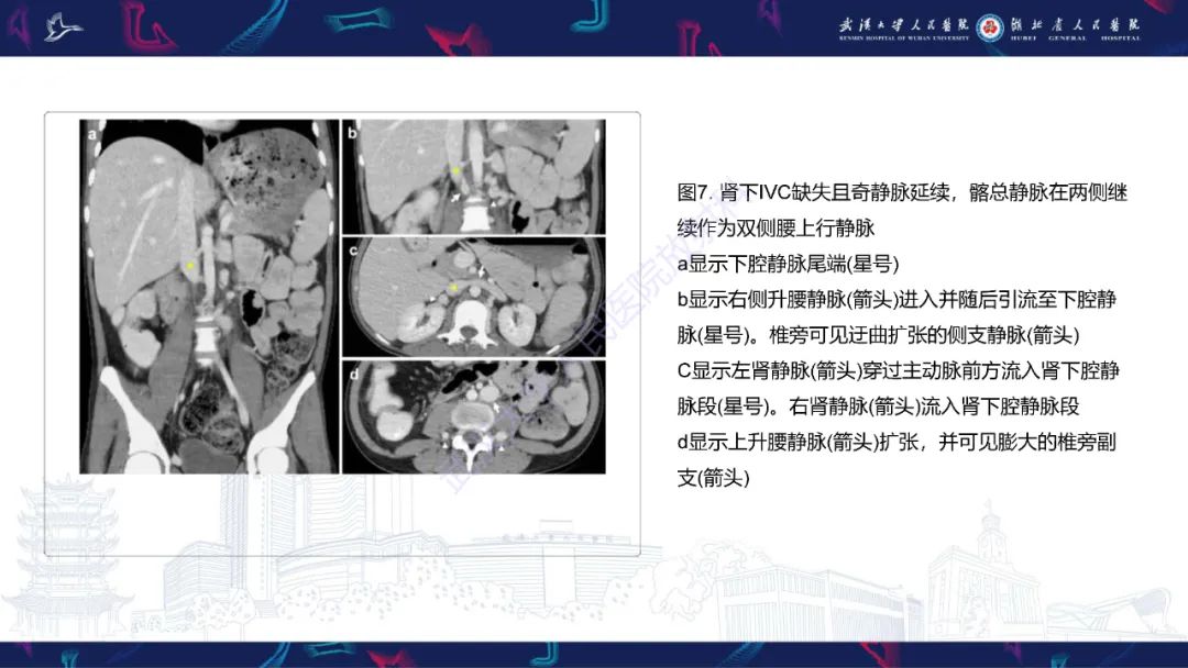 影像PPT - 【PPT】下腔静脉解剖变异及病变影像诊断-11