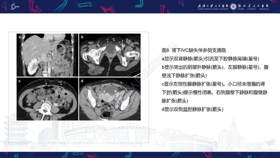 影像PPT - 【PPT】下腔静脉解剖变异及病变影像诊断-12
