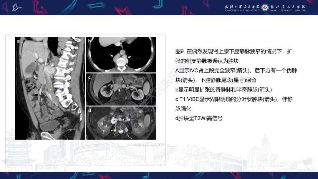 影像PPT - 【PPT】下腔静脉解剖变异及病变影像诊断-14