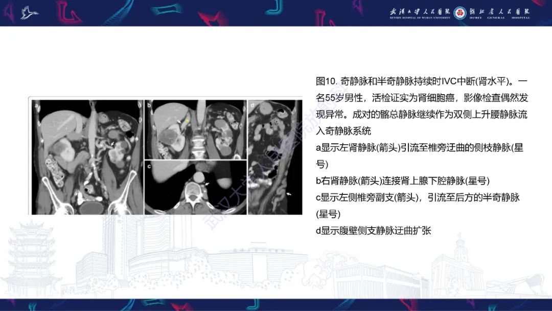影像PPT - 【PPT】下腔静脉解剖变异及病变影像诊断-15
