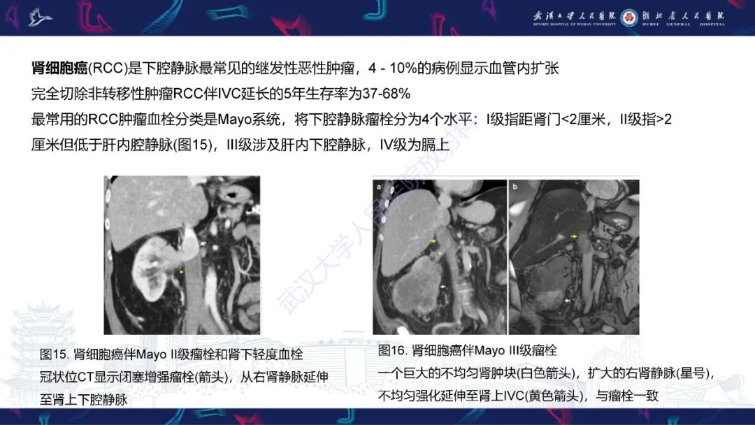 影像PPT - 【PPT】下腔静脉解剖变异及病变影像诊断-20