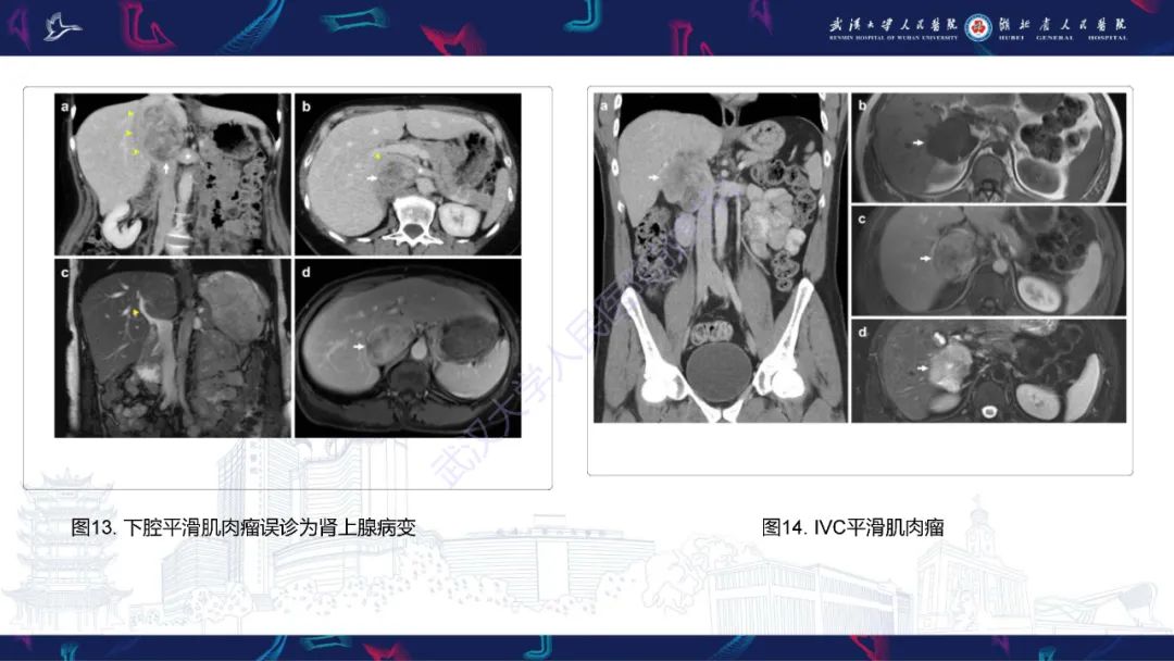 影像PPT - 【PPT】下腔静脉解剖变异及病变影像诊断-18