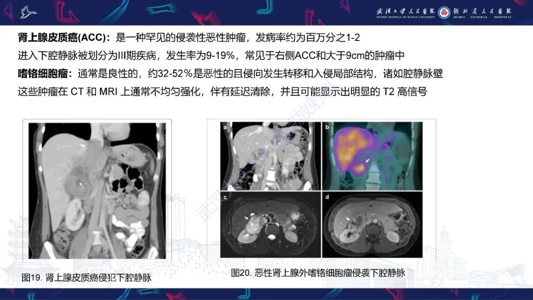 影像PPT - 【PPT】下腔静脉解剖变异及病变影像诊断-22