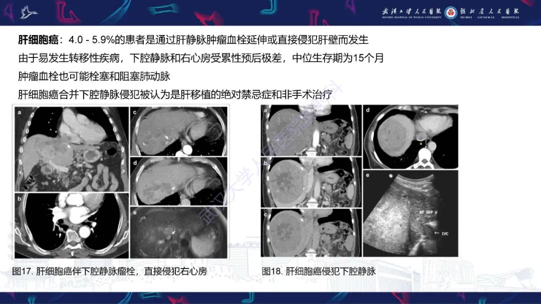 影像PPT - 【PPT】下腔静脉解剖变异及病变影像诊断-21