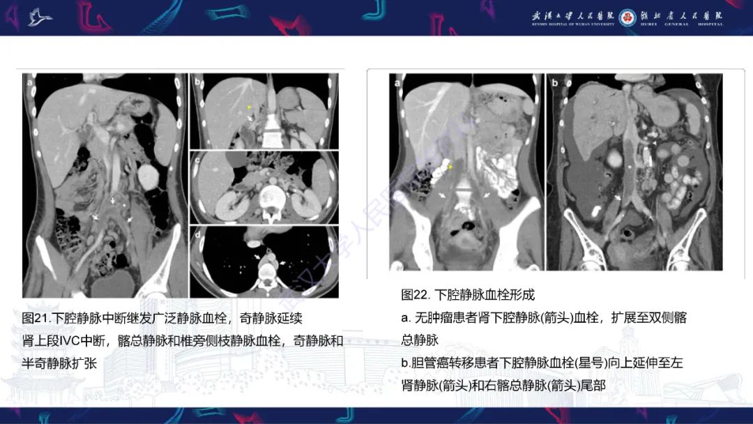 影像PPT - 【PPT】下腔静脉解剖变异及病变影像诊断-24