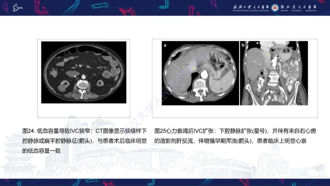 影像PPT - 【PPT】下腔静脉解剖变异及病变影像诊断-26