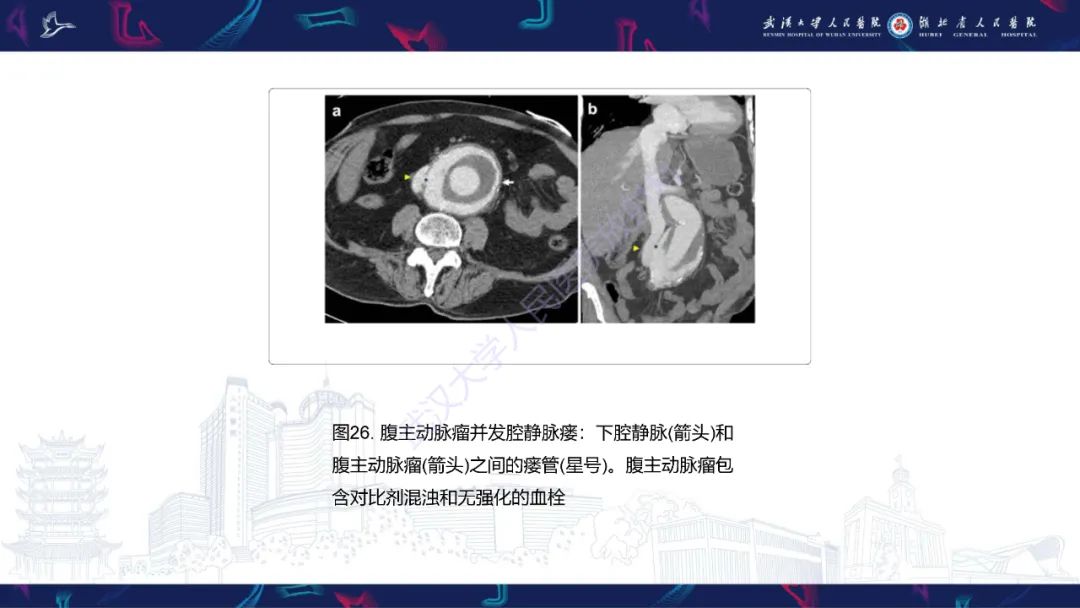 影像PPT - 【PPT】下腔静脉解剖变异及病变影像诊断-27