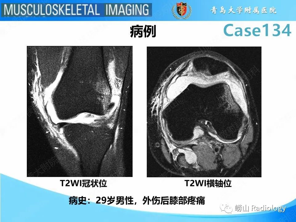 影像PPT - 【PPT】髌骨外侧脱位-2