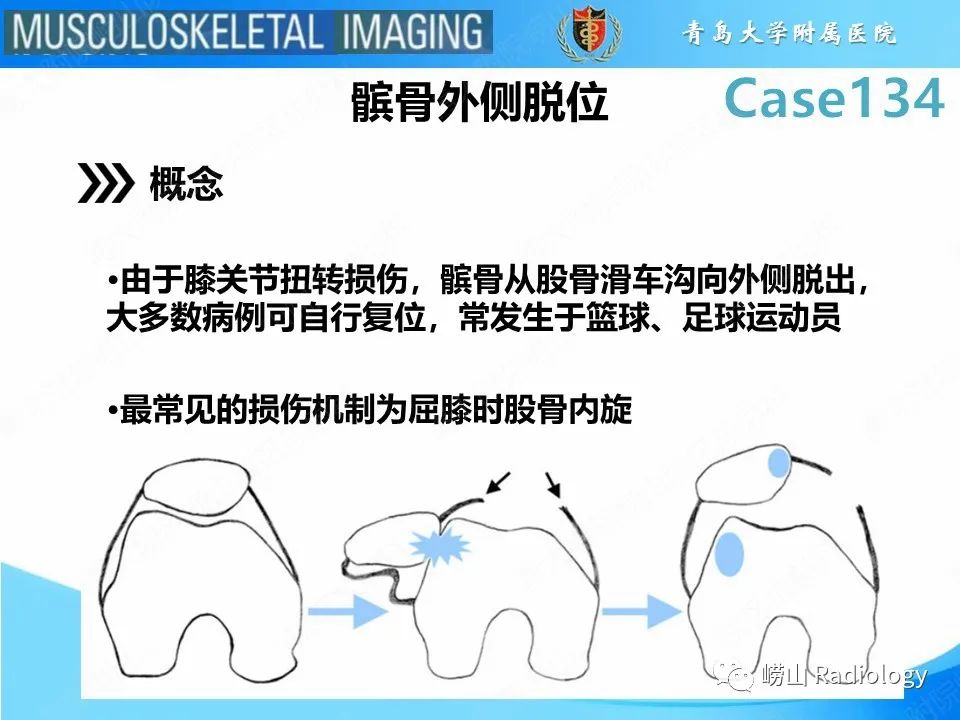 影像PPT - 【PPT】髌骨外侧脱位-7