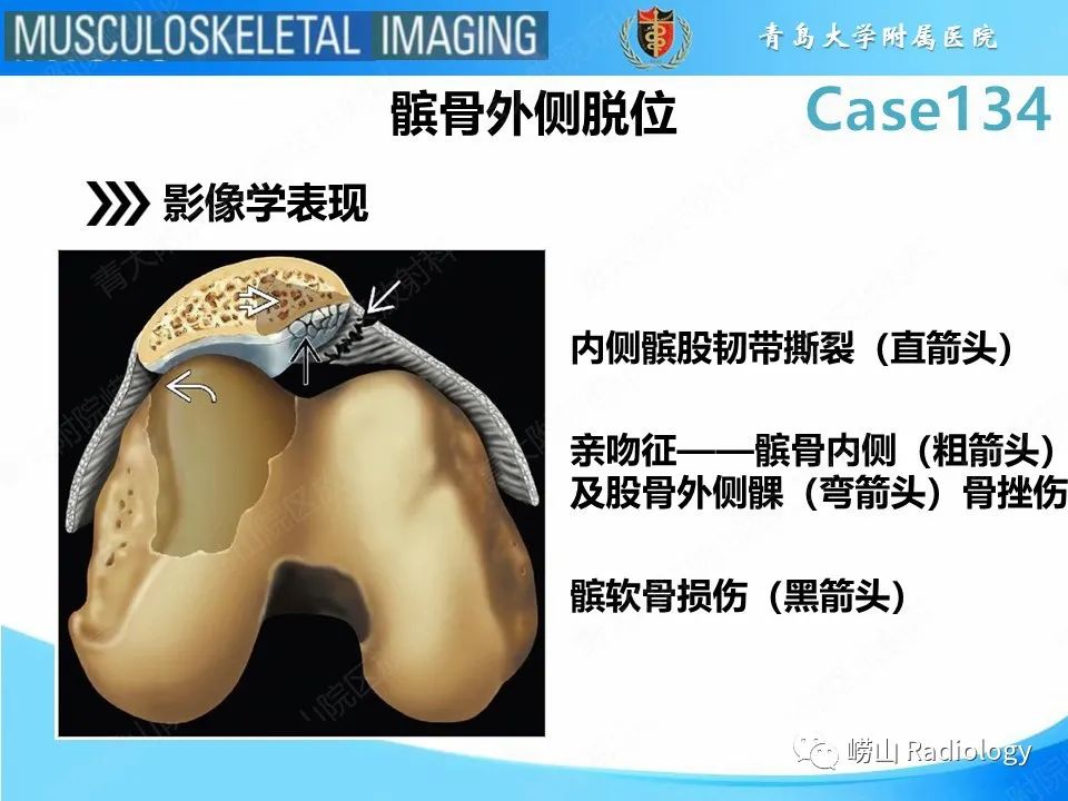 影像PPT - 【PPT】髌骨外侧脱位-9