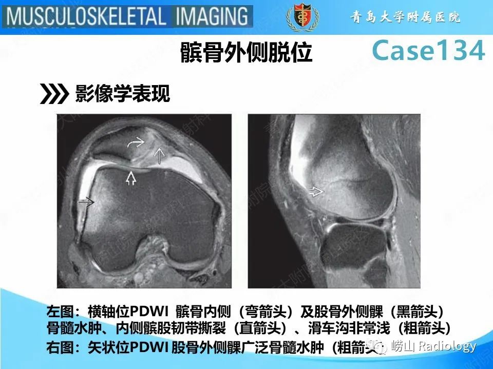 影像PPT - 【PPT】髌骨外侧脱位-10